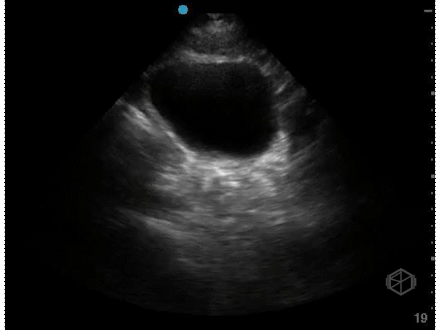 Bladder Sagittal (Male)