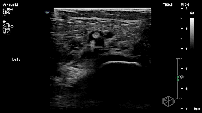 Highly echogenic thrombus visible.