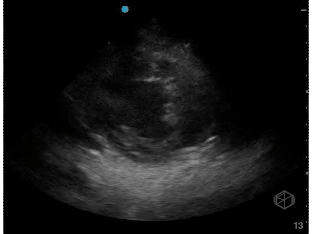 Moderately hypodynamic LVEF (~30's)
