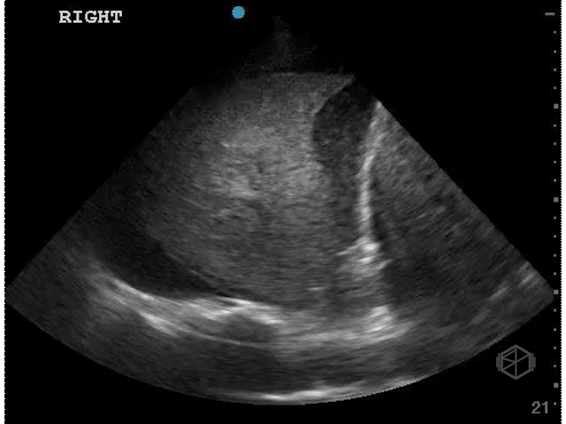 Pleural effusion demonstrating the "plankton" sign which indicates hyperechoic debris swirling around suggestive of exudative effusion.