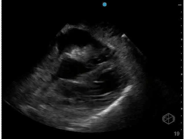 Right ventricular diastolic collapse