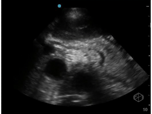 Normal Proximal Aorta