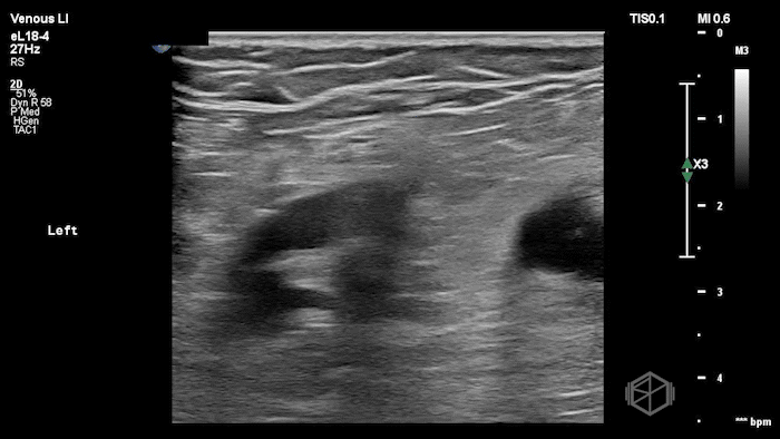 Hypoechoic appearing Baker's cyst.