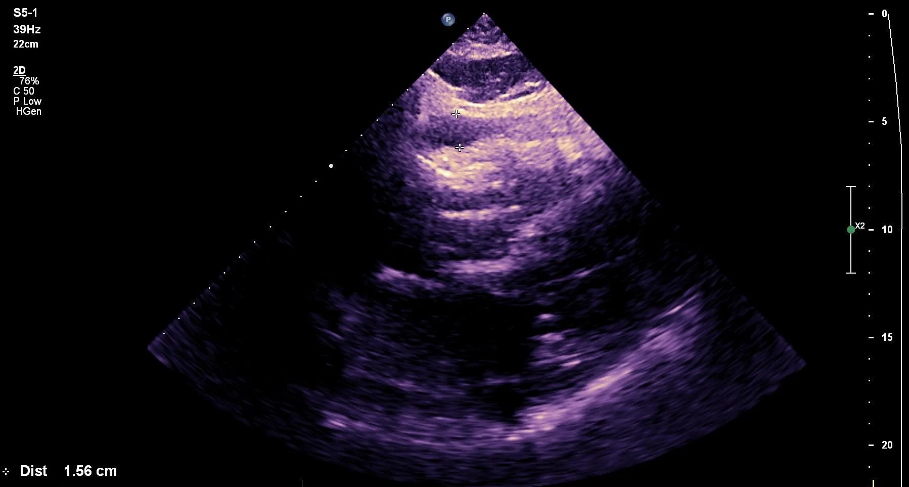 SX pericardial effusion measurement