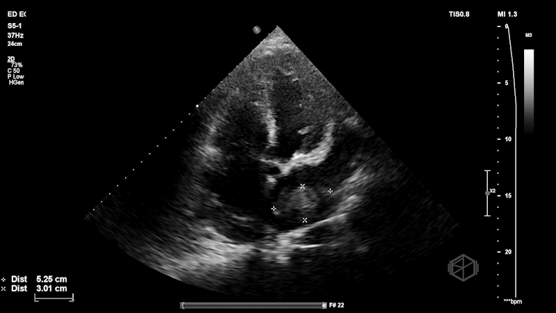 Left Atrial Mass Measurement.gif