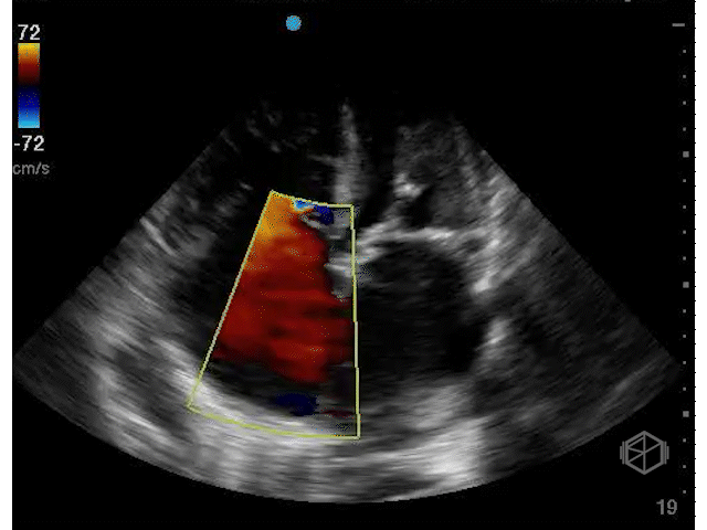 Severe Tricuspid Regurgiation