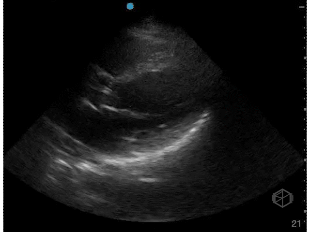 Moderately Hypodynamic LVEF (~35%)