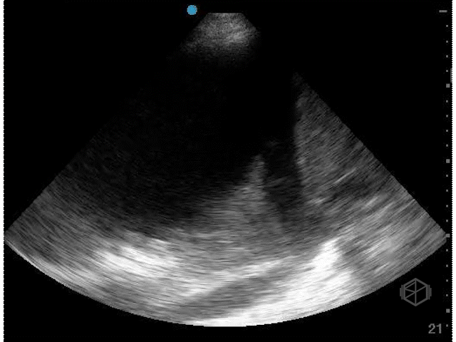   Jellyfish sign   — atelectatic lung floating within the pleural effusion; generally a sign of atelectasis over consolidation. Demonstrates the true tissue architecture of the lung.