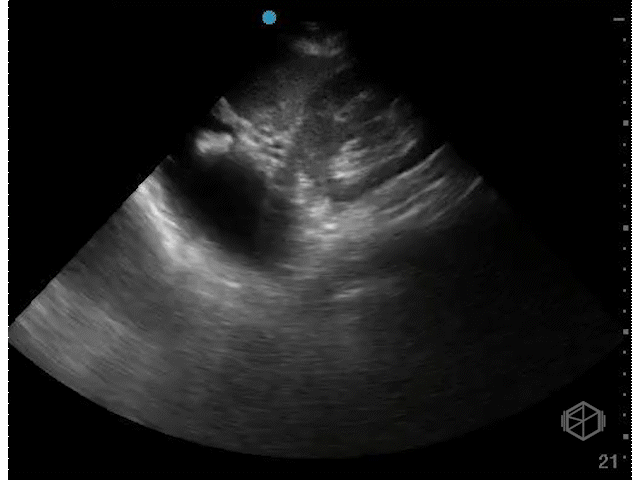 Stomach as false positive in the LUQ.