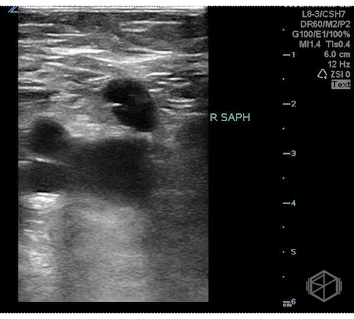 Saphenous vein thrombosis