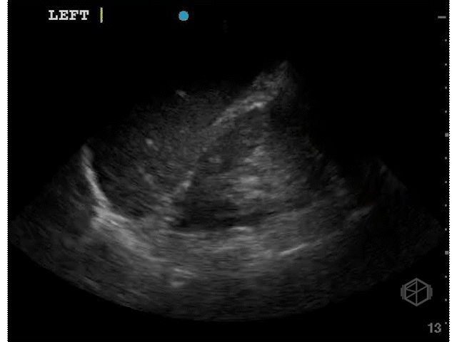 Normal lung base demonstrating the mirror image artifact. No spine is visualized above the diaphragm.