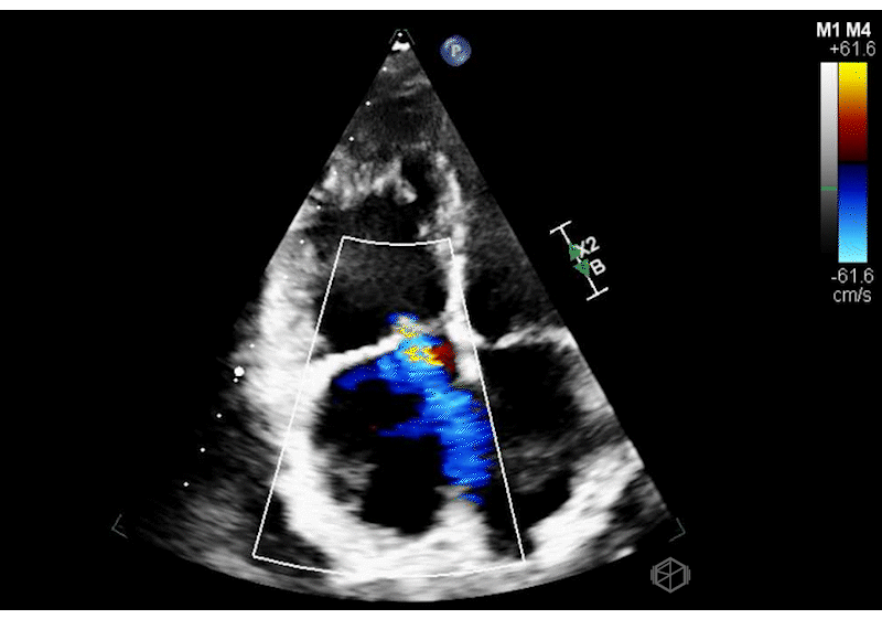 Moderate to Severe Tricuspid Regurgitation