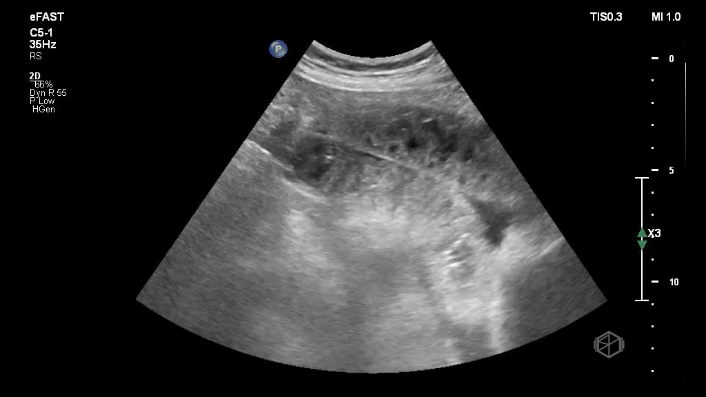 Bowel wall with comet tail artifacts indicating likely gangrenous bowel. Free fluid is present.
