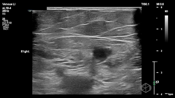 Saphenous vein demonstrating thrombus.