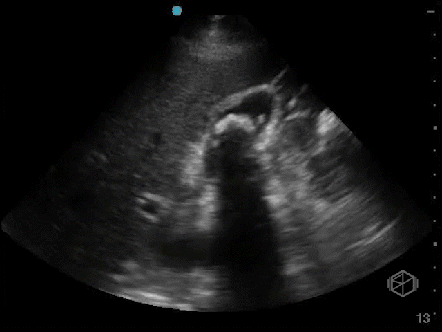 Gallbladder wall edema from acute cholecystitis, patient had positive sonographic Murphy's.