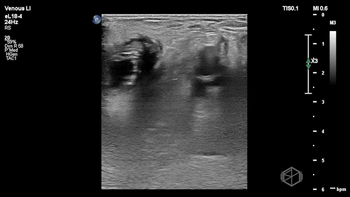 Heterogenous appearing Baker's cyst.