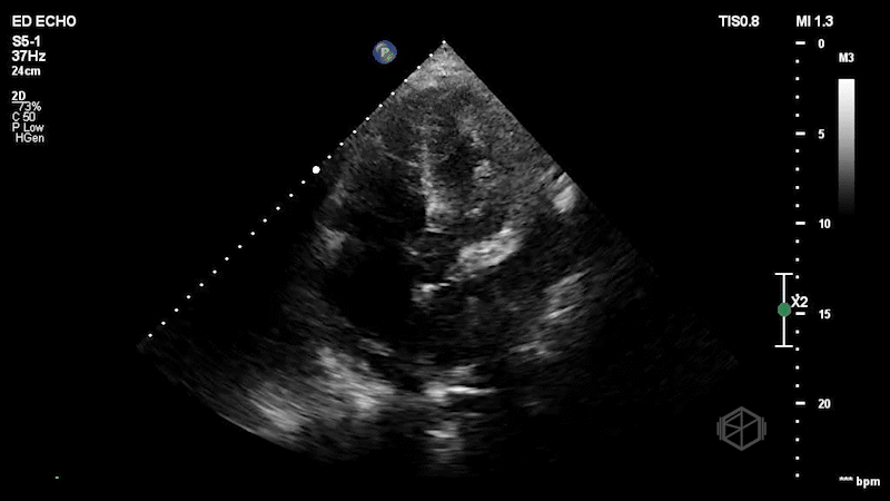Left Atrial Mass Subtly Visible