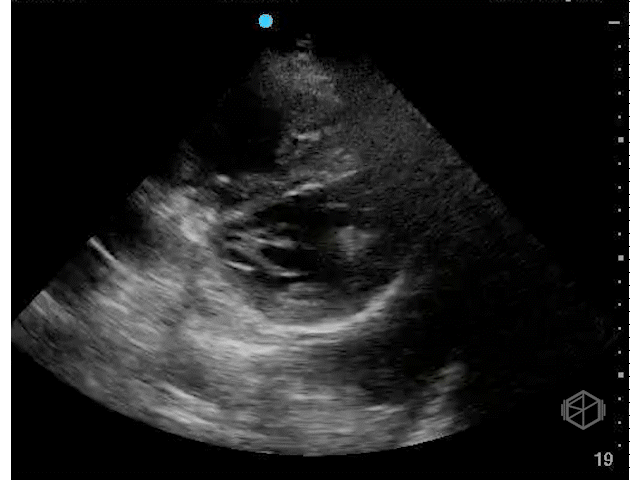 RV pressure overload — notice how the septum stays flattened during both systole and diastole (pulmonary hypertension).
