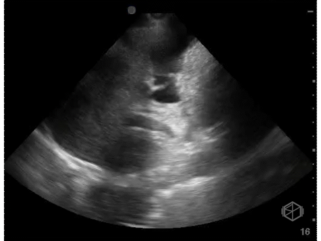 Gallbladder as a false positive