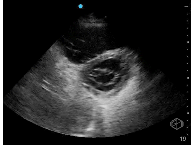 RV volume overload — subtle D-sign (septic shock leading to ARDS with increased PVR leading to right heart volume overload).