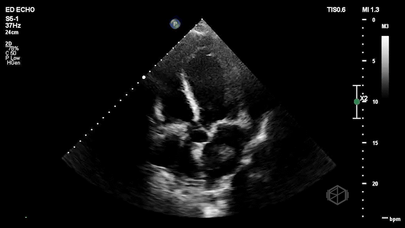 Left Atrial Mass Subtly Visible