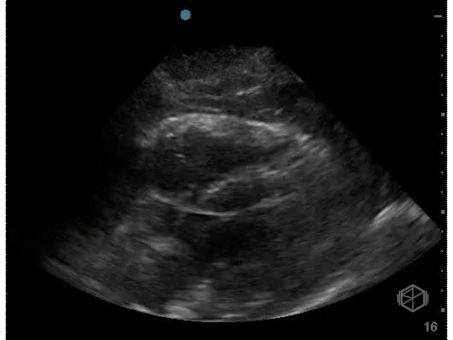 Hemorrhagic pericardial effusion — note how the complex fluid goes beyond the right heart and is circumferential.