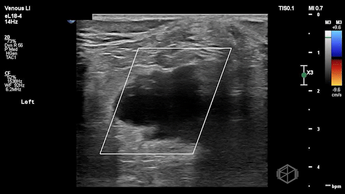 Hypoechoic appearing Baker's cyst demonstrating no internal flow.