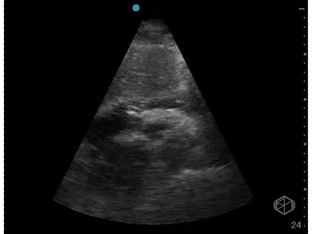 Prominent pericardial fat pad (with trace effusion)