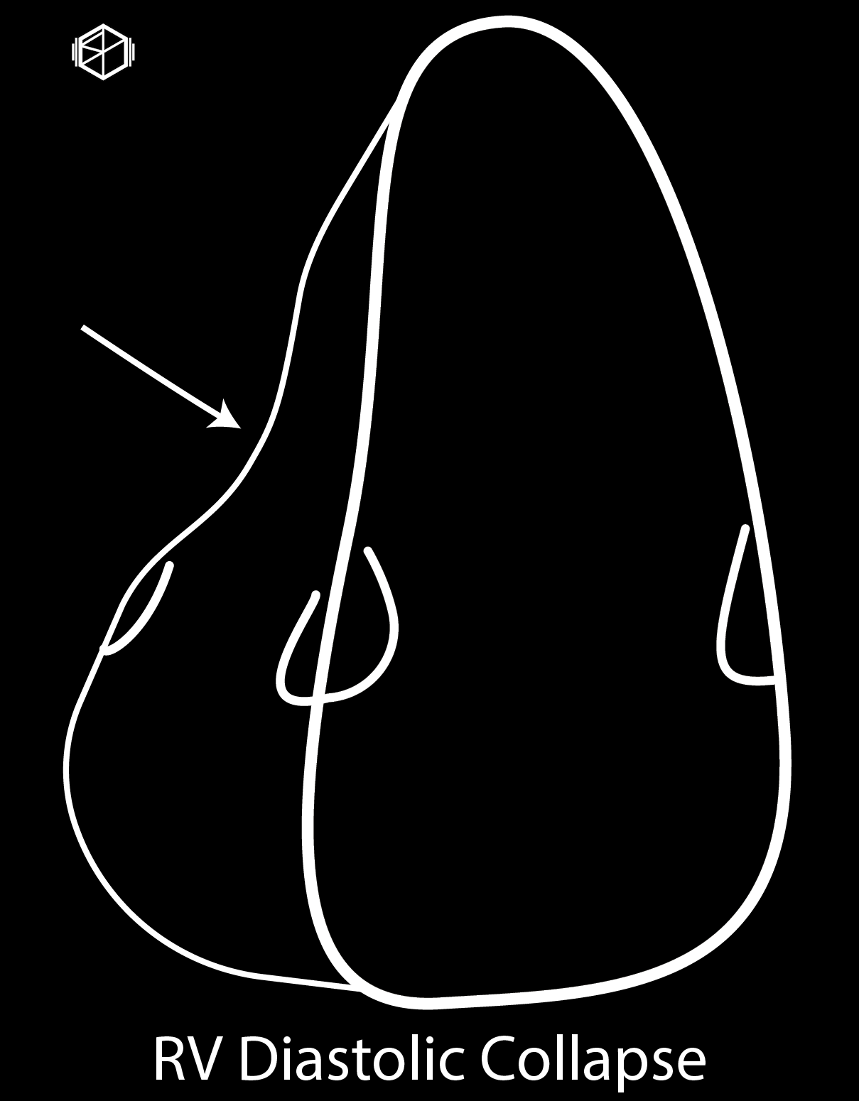 TamponadeHeartRVDiastolicCollapse-01_10.png
