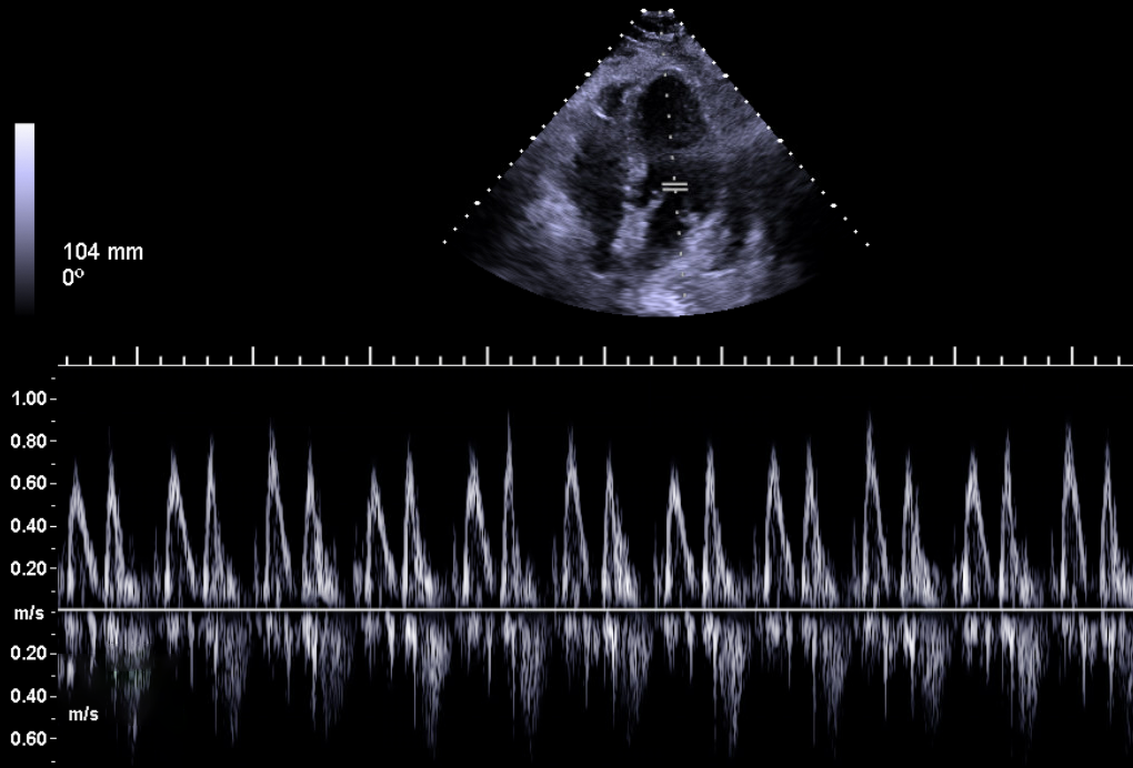 Normal mitral inflow variation