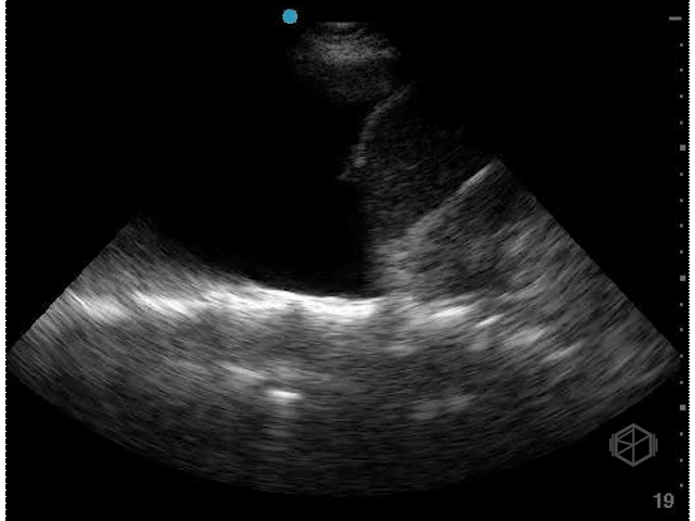  Spine sign  — pleural effusions allow the transmission of ultrasound waves, thus the normally non-visualized spine becomes visible. Here a simple effusion is demonstrated.