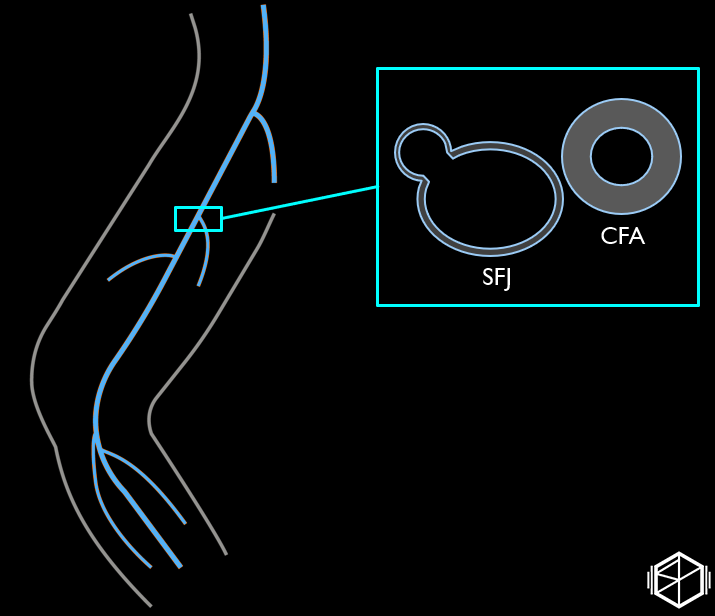 Saphenofemoral junction, anatomy sketch