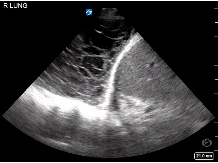 Complex pleural effusion demonstrating multiple septations.