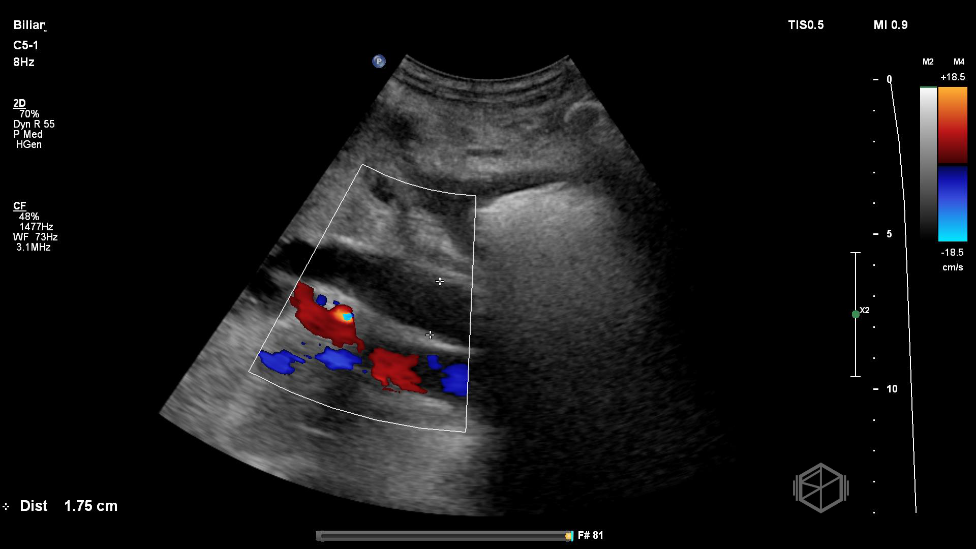 Significantly dilated CBD due to choledocholithiasis