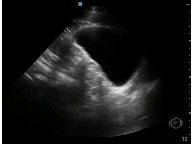 Bladder Sagittal (Male)