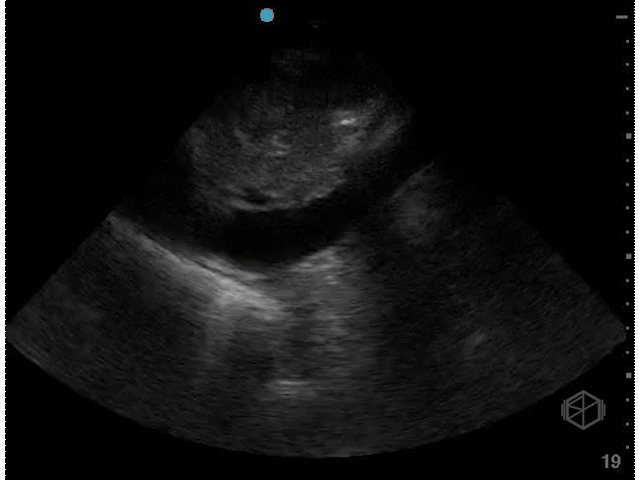 Plethoric IVC