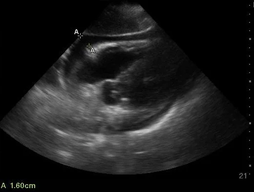 SX pericardial effusion measurement