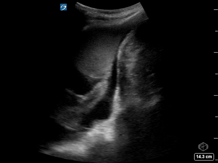 Hematocrit sign — a bi-layering phenomenon when heavier cellular elements collect in gravity dependent portions and appears highly echogenic. Highly suggestive of   hemothorax  .