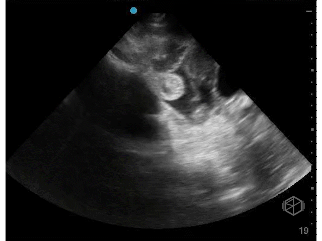 +Free fluid in female, sagittal view.