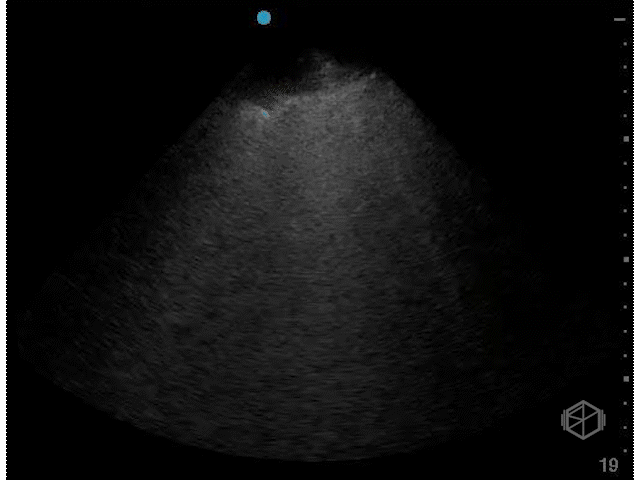 B'-profile — abolished lung sliding with B-lines, indicative of an acute interstitial syndrome (eg, ARDS or pneumonia).