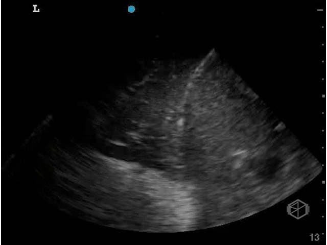 Hepatization — liver-like appearance of the lung tissue. Note the air bronchograms.