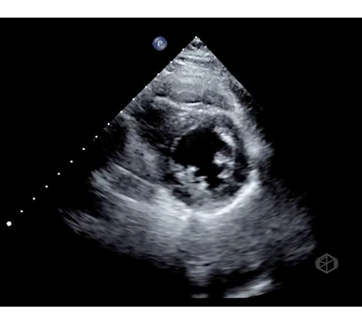 Normal LVEF (~55%)