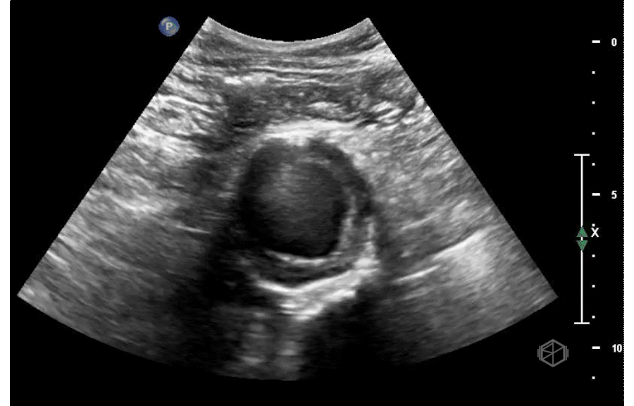 AAA with intraluminal thrombus.