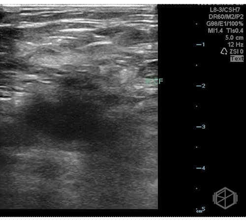 Saphenous vein thrombosis