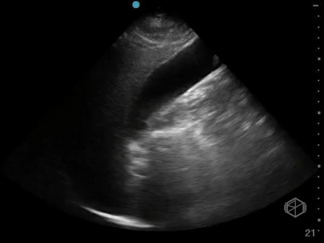 Significantly elongated gallbladder, acutely inflamed gallbladder with hydrops operatively.