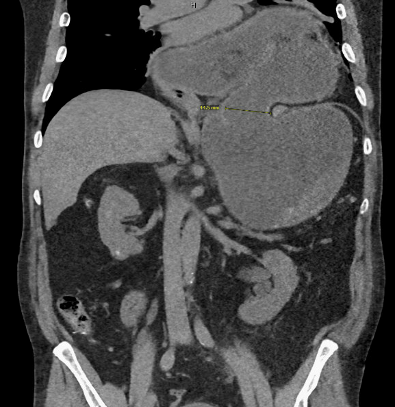 CT scan showing marked distention of the stomach with a large hiatal hernia and gastric volvulus with obstruction of the gastroduodenal junction and lesser obstruction at the gastric body most likely representing an organoaxial gastric volvulus.