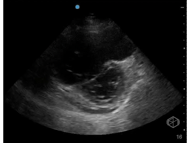 RV volume overload — note how the LV turns into a circular shape (chronic right heart failure with fluid overload).