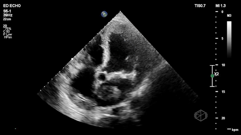 Left Atrial Mass Visible at Higher Gain