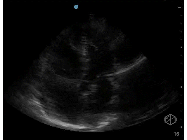 RV Dilatation.gif