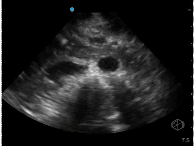 Distal aorta to iliacs